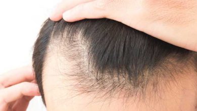 Hair diseases